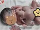 深圳一男婴出生时4手4脚 胸部与寄生胎相连